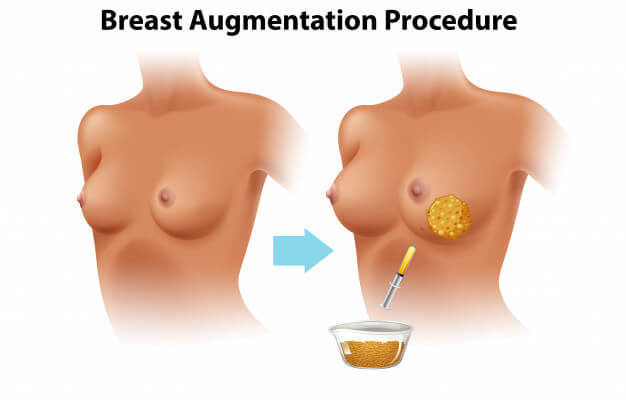 Breast Enlargement with Your Own Body Fat