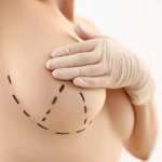 Surgical Procedures in Breast Uplift