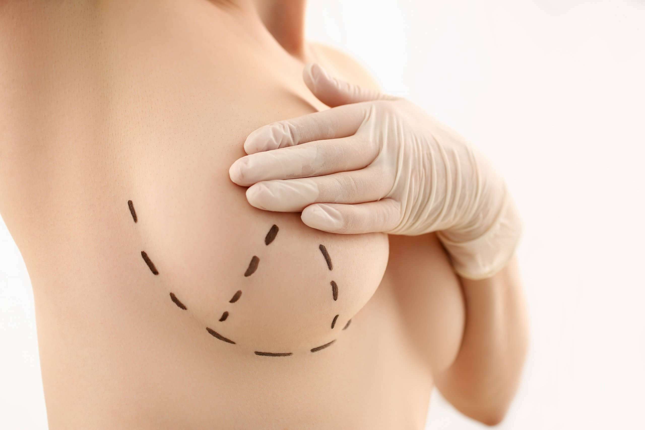 Breast Uplift Privia Clinic